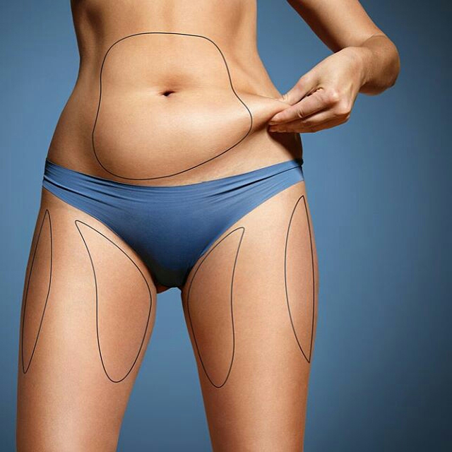 liposuction surgery, laser lipo, smart lipo