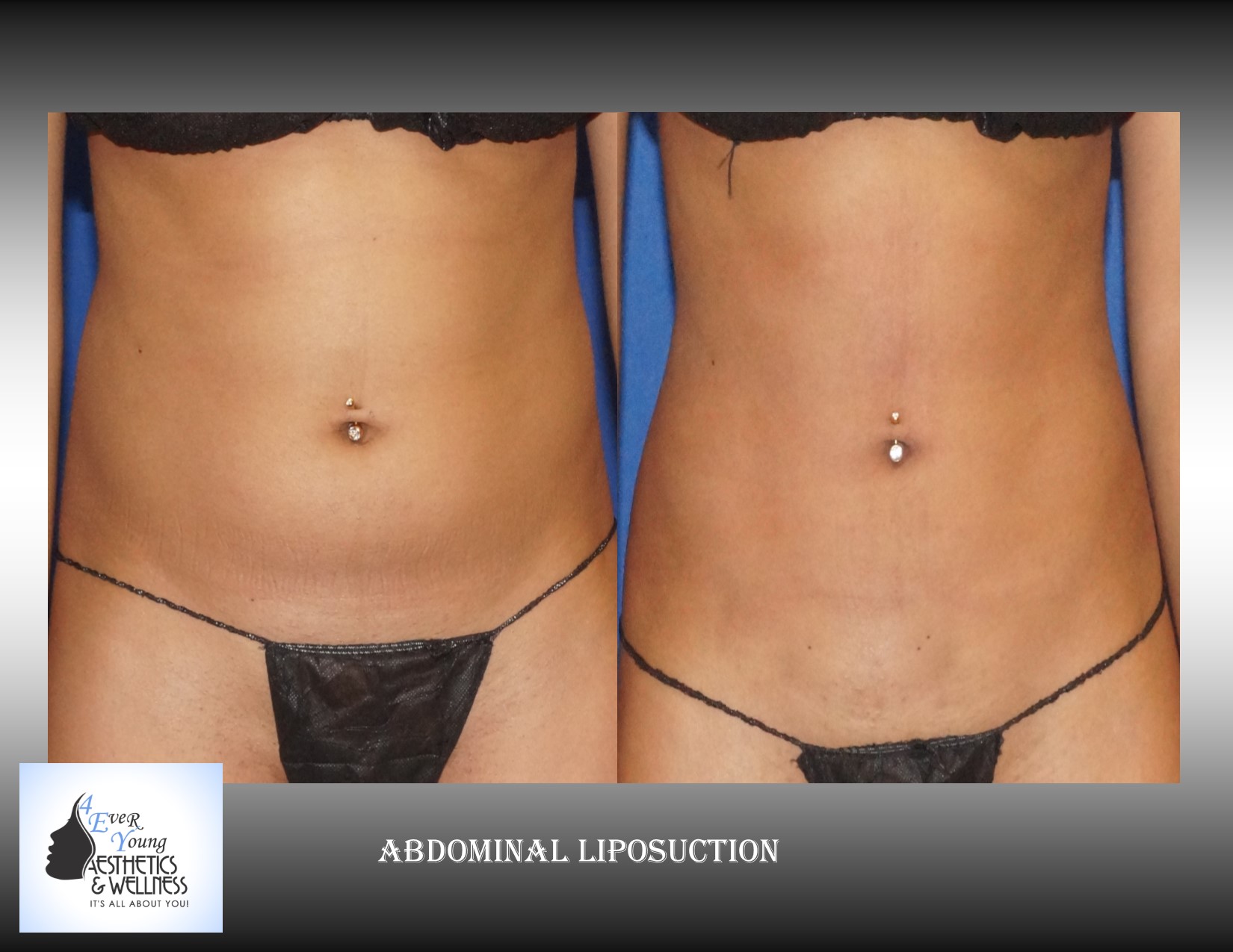 Liposuction is performed using tumescent anesthesia and traditional liposuction plastic surgery.  We are experts in laser liposuction (smartlipo), vaser liposuction and fat transfer, also known as fat grafting.  Our board-certified cosmetic surgeon is an expert at fat removal with liposuction which is an enhancement surgery and doesn’t fall into the scope of practice of a board-certified plastic surgeon who is trained in reconstructive surgery.  Board-certified plastic surgeons with experience in liposuction are certainly qualified to perform the procedure but being trained strictly in plastic surgery is misleading.  We use abdominal liposuction, flank liposuction, back liposuction, arm liposuction, thigh liposuction and ankle liposuction to remove unsightly fat from problem areas with our tumescent liposuction procedures with or without sedation. If you desire we use autologous fat transfer (fat grafting) to use the fat obtained as the most natural dermal filler unlike synthetic fillers (Restylane, Juvederm, Sculptra, Radiesse, Belotero, Perlane) to improve fine lines and wrinkles of the face, hand rejuvenation with fat, fat transfer to breast, Brazilian Butt Lift (Butt Augmentation), liposculpture, lip augmentation with fat.  Fat transfer to the breast can be a great alternative to breast augmentation, saline implants, silicone implants, breast augmentation with mastopexy or just to improve volume in the upper pole of the breast.    