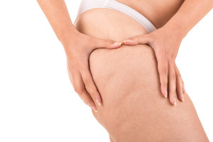 4Ever Young Cellulite Treatments