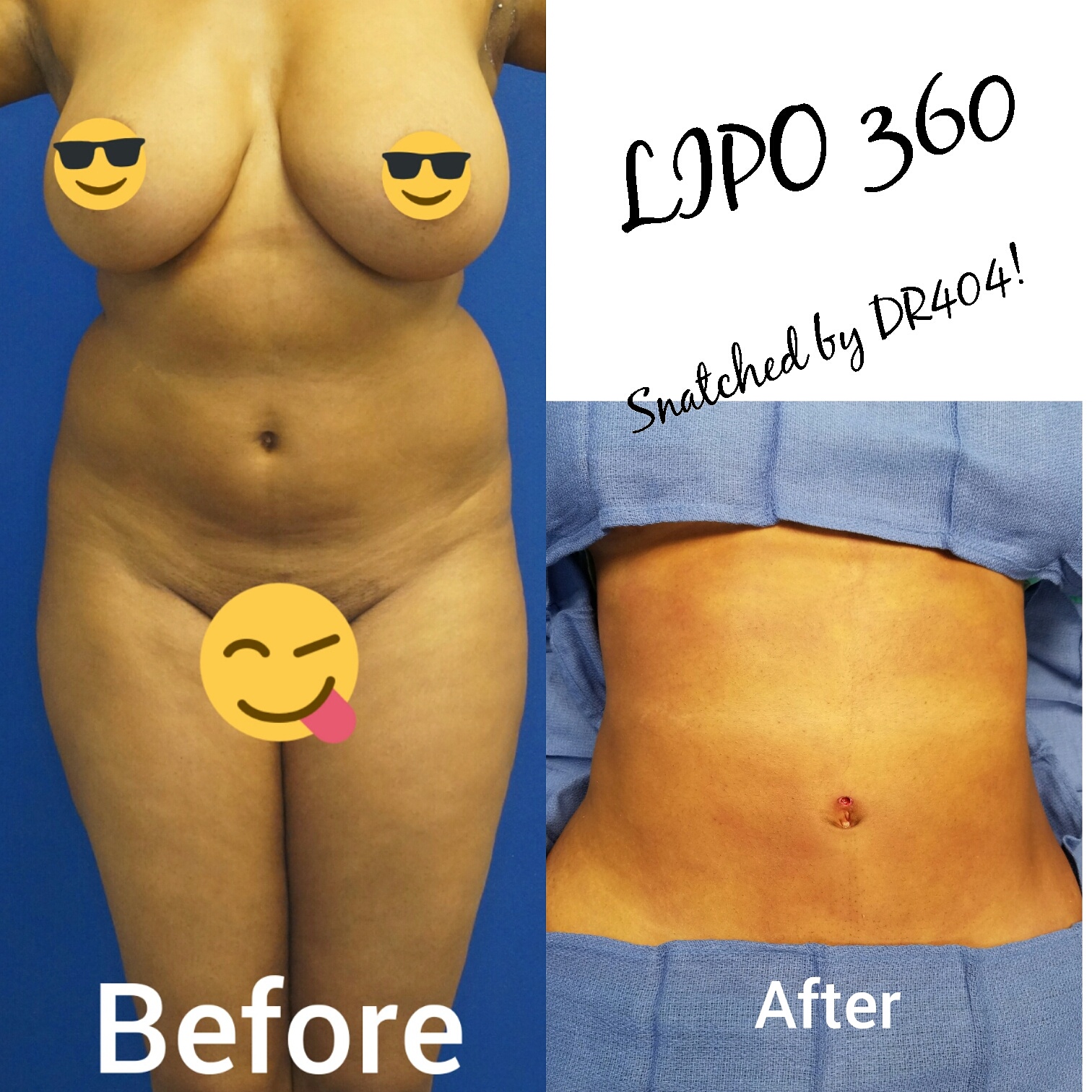 liposuction surgery, laser lipo, smart lipoAtlanta liposuction, liposuction atlanta, atlanta brazilian butt lift, brazilian butt lift atlanta, therealdrmiami, drmiami, dr404, atlanta tummy tuck, tummy tuck atlanta, lipo360, liposuction360