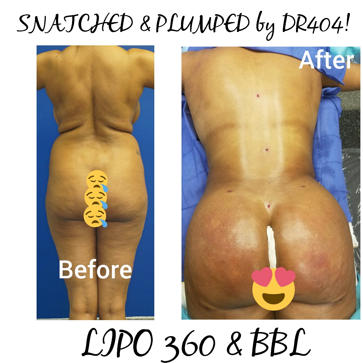 Atlanta Brazilian Butt Lift, Brazilian Butt Lift (BBL) utilizes liposuction plastic surgery performed by our liposuction surgeon. Liposuction is performed using tumescent anesthesia and traditional liposuction plastic surgery.  We are experts in laser liposuction (smartlipo), vaser liposuction and fat transfer, also known as fat grafting.  Brazilian butt lift atlanta has been popularized by Dr. Curves and others like therealdrmiami of snapchat fame have made Brazilian butt lifts extremely popular in recent years. Our autologous fat transfer is second to none and we utilize Platelet-Rich Plasma (PRP) which helps stabilize the fat transfer faster by promoting blood vessels to grow into the fat grafting. Most people think that a Brazilian butt lift (BBL) is a plastic surgery procedure but instead it is a cosmetic surgery procedure strictly performed for enhancement of the buttock area to transform your butt into the big Brazilian butt and replicate the popular Brazilian ass that Brazilian butt women have been getting Brazilian butt lifts to have for years.  As part of our mommy makeover packages you can combine a Brazilian ass with a tummy tuck and/or breast augmentation with a mastopexy, which is more commonly associated with a mommy makeover.