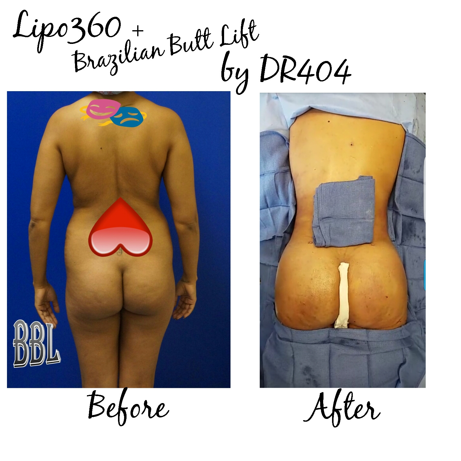 Brazilian Butt Lift with Threads, Brazilian Butt Lift (BBL) utilizes liposuction plastic surgery performed by our liposuction surgeon. Liposuction is performed using tumescent anesthesia and traditional liposuction plastic surgery.  We are experts in laser liposuction (smartlipo), vaser liposuction and fat transfer, also known as fat grafting.  Brazilian butt lift atlanta has been popularized by Dr. Curves and others like therealdrmiami of snapchat fame have made Brazilian butt lifts extremely popular in recent years. Our autologous fat transfer is second to none and we utilize Platelet-Rich Plasma (PRP) which helps stabilize the fat transfer faster by promoting blood vessels to grow into the fat grafting. Most people think that a Brazilian butt lift (BBL) is a plastic surgery procedure but instead it is a cosmetic surgery procedure strictly performed for enhancement of the buttock area to transform your butt into the big Brazilian butt and replicate the popular Brazilian ass that Brazilian butt women have been getting Brazilian butt lifts to have for years.  As part of our mommy makeover packages you can combine a Brazilian ass with a tummy tuck and/or breast augmentation with a mastopexy, which is more commonly associated with a mommy makeover.