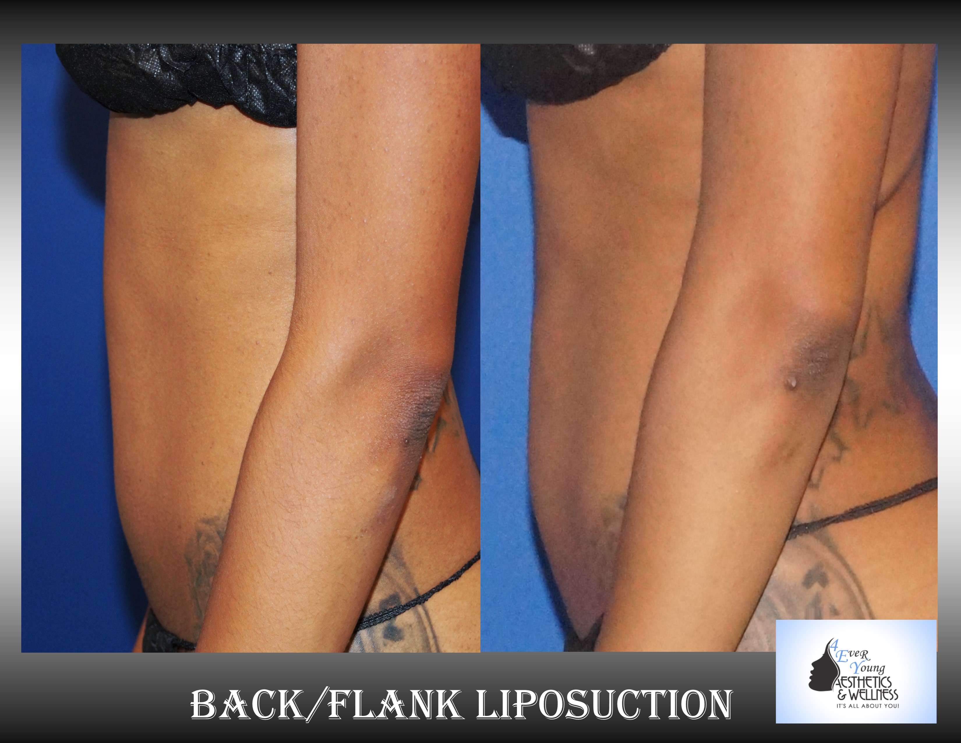 Atlanta liposuction, Liposuction is performed using tumescent anesthesia and traditional liposuction plastic surgery.  We are experts in laser liposuction (smartlipo), vaser liposuction and fat transfer, also known as fat grafting.  Our board-certified cosmetic surgeon is an expert at fat removal with liposuction which is an enhancement surgery and doesn’t fall into the scope of practice of a board-certified plastic surgeon who is trained in reconstructive surgery.  Board-certified plastic surgeons with experience in liposuction are certainly qualified to perform the procedure but being trained strictly in plastic surgery is misleading.  We use abdominal liposuction, flank liposuction, back liposuction, arm liposuction, thigh liposuction and ankle liposuction to remove unsightly fat from problem areas with our tumescent liposuction procedures with or without sedation. If you desire we use autologous fat transfer (fat grafting) to use the fat obtained as the most natural dermal filler unlike synthetic fillers (Restylane, Juvederm, Sculptra, Radiesse, Belotero, Perlane) to improve fine lines and wrinkles of the face, hand rejuvenation with fat, fat transfer to breast, Brazilian Butt Lift (Butt Augmentation), liposculpture, lip augmentation with fat.  Fat transfer to the breast can be a great alternative to breast augmentation, saline implants, silicone implants, breast augmentation with mastopexy or just to improve volume in the upper pole of the breast.    