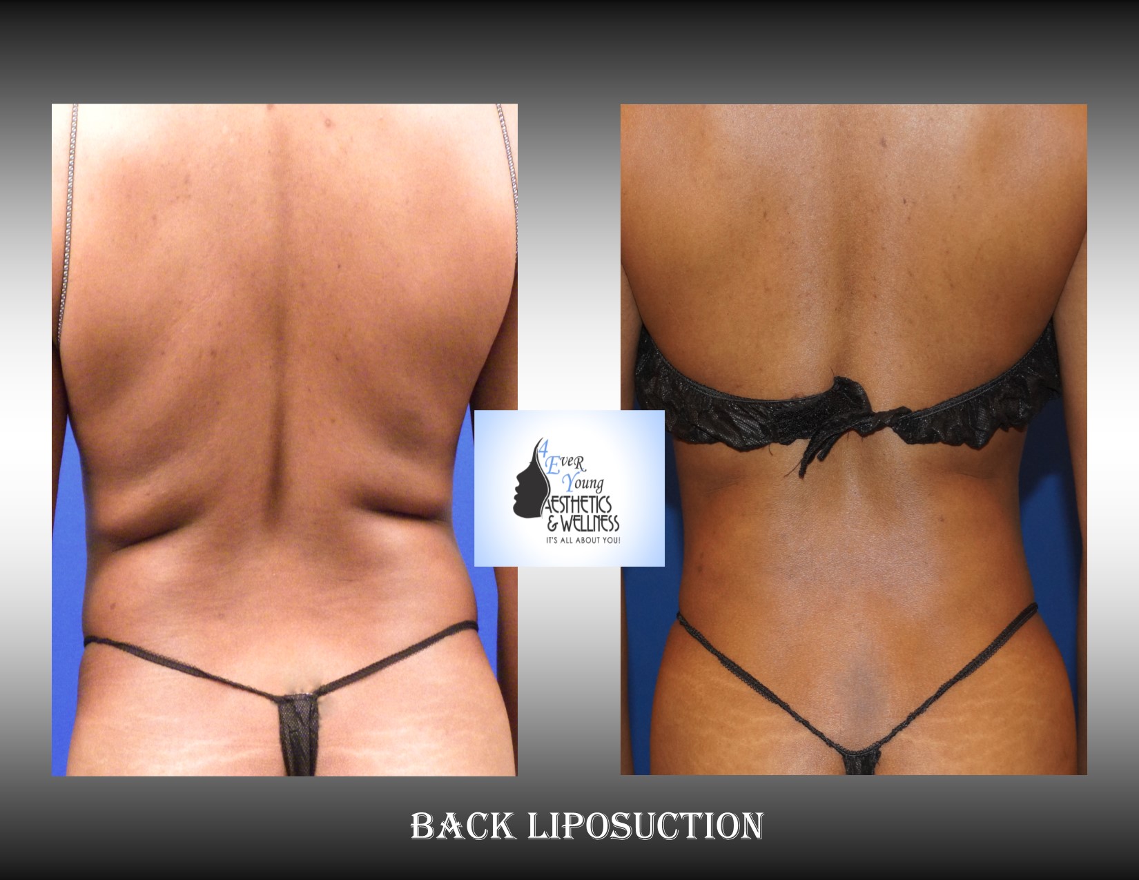 Liposuction plastic surgery is performed using tumescent anesthesia and traditional liposuction plastic surgery.  We are experts in laser liposuction (smartlipo), vaser liposuction and fat transfer, also known as fat grafting.  Our board-certified cosmetic surgeon is an expert at fat removal with liposuction which is an enhancement surgery and doesn’t fall into the scope of practice of a board-certified plastic surgeon who is trained in reconstructive surgery.  Board-certified plastic surgeons with experience in liposuction are certainly qualified to perform the procedure but being trained strictly in plastic surgery is misleading.  We use abdominal liposuction, flank liposuction, back liposuction, arm liposuction, thigh liposuction and ankle liposuction to remove unsightly fat from problem areas with our tumescent liposuction procedures with or without sedation. If you desire we use autologous fat transfer (fat grafting) to use the fat obtained as the most natural dermal filler unlike synthetic fillers (Restylane, Juvederm, Sculptra, Radiesse, Belotero, Perlane) to improve fine lines and wrinkles of the face, hand rejuvenation with fat, fat transfer to breast, Brazilian Butt Lift (Butt Augmentation), liposculpture, lip augmentation with fat.  Fat transfer to the breast can be a great alternative to breast augmentation, saline implants, silicone implants, breast augmentation with mastopexy or just to improve volume in the upper pole of the breast.    