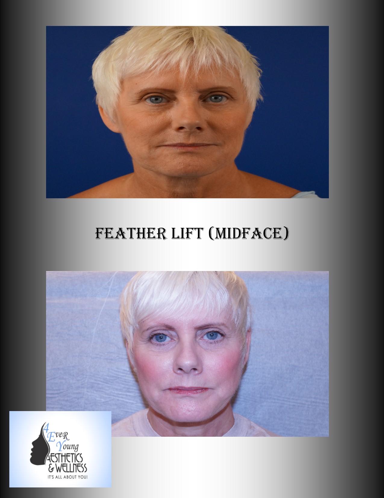 Feather Lift, Face Lift, facial rejuvenation, 