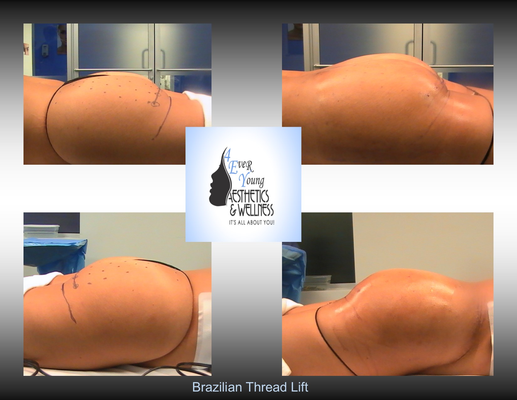 Brazilian Butt Lift, with Threads, Brazilian Butt Lift (BBL) utilizes liposuction plastic surgery performed by our liposuction surgeon. Liposuction is performed using tumescent anesthesia and traditional liposuction plastic surgery.  We are experts in laser liposuction (smartlipo), vaser liposuction and fat transfer, also known as fat grafting.  Brazilian butt lift atlanta has been popularized by Dr. Curves and others like therealdrmiami of snapchat fame have made Brazilian butt lifts extremely popular in recent years. Our autologous fat transfer is second to none and we utilize Platelet-Rich Plasma (PRP) which helps stabilize the fat transfer faster by promoting blood vessels to grow into the fat grafting. Most people think that a Brazilian butt lift (BBL) is a plastic surgery procedure but instead it is a cosmetic surgery procedure strictly performed for enhancement of the buttock area to transform your butt into the big Brazilian butt and replicate the popular Brazilian ass that Brazilian butt women have been getting Brazilian butt lifts to have for years.  As part of our mommy makeover packages you can combine a Brazilian ass with a tummy tuck and/or breast augmentation with a mastopexy, which is more commonly associated with a mommy makeover.
