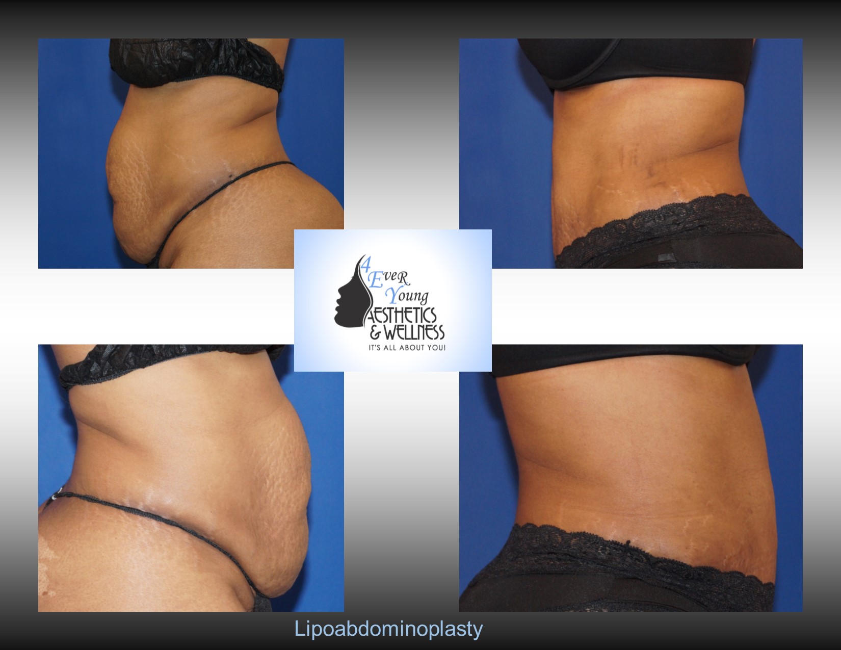 Tummy Tuck Atlanta, Tummy Tuck, also known as abdominoplasty, lipoabdominoplasty, liposuction tummy tuck, is a procedure to that corrects a rectus diasthasis and removes excess or poor quality skin from the abdomen. We combine our tummy tuck with liposuction in order to contour the body resulting in a flat stomach with scars that are placed low in the bikini line. Our liposuction is accomplished by either traditional tumescent liposuction, laser liposuction (Smartlipo), vaser liposuction with the use of a power assisted liposuction handle to remove fat more thoroughly and rapidly. We use abdominal liposuction, flank liposuction, back liposuction, arm liposuction, thigh liposuction and ankle liposuction to remove unsightly fat from problem areas with our tumescent liposuction procedures with or without sedation. If you desire we use autologous fat transfer (fat grafting) to use the fat obtained as the most natural dermal filler unlike synthetic fillers (Restylane, Juvederm, Sculptra, Radiesse, Belotero, Perlane) to improve fine lines and wrinkles of the face, hand rejuvenation with fat, fat transfer to breast, Brazilian Butt Lift (Butt Augmentation), liposculpture, lip augmentation with fat.  Fat transfer to the breast can be a great alternative to breast augmentation, saline implants, silicone implants, breast augmentation with mastopexy or just to improve volume in the upper pole of the breast. Our autologous fat transfer is second to none and we utilize Platelet-Rich Plasma (PRP) which helps stabilize the fat transfer faster by promoting blood vessels to grow into the fat grafting. Most people think that a Brazilian butt lift (BBL) is a plastic surgery procedure but instead it is a cosmetic surgery procedure strictly performed for enhancement of the buttock area to transform your butt into the big Brazilian butt and replicate the popular Brazilian ass that Brazilian butt women have been getting Brazilian butt lifts to have for years.  As part of our mommy makeover packages you can combine a Brazilian ass with a tummy tuck and/or breast augmentation with a mastopexy, which is more commonly associated with a mommy makeover, brazilian butt lift atlanta, atlanta brazilian butt lift, liposuction plastic surgery, liposuction, laser liposuction. fat grafting, brazilian ass, brazilian butt women, fat transfer, botox, plastic surgery, cosmetic surgery, plastic surgeon, cosmetic surgeon