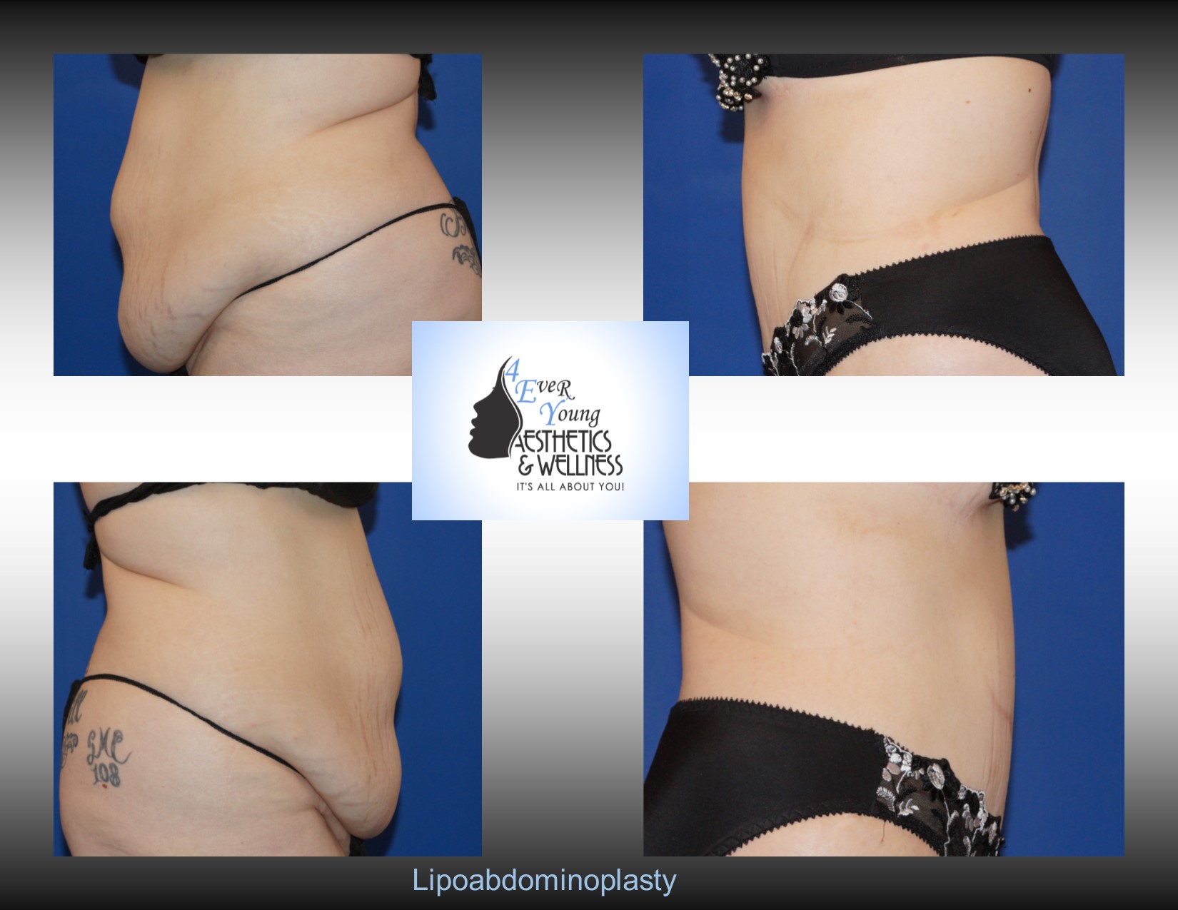 Atlanta Tummy Tuck,Tummy Tuck, also known as abdominoplasty, lipoabdominoplasty, liposuction tummy tuck, is a procedure to that corrects a rectus diasthasis and removes excess or poor quality skin from the abdomen. We combine our tummy tuck with liposuction in order to contour the body resulting in a flat stomach with scars that are placed low in the bikini line. Our liposuction is accomplished by either traditional tumescent liposuction, laser liposuction (Smartlipo), vaser liposuction with the use of a power assisted liposuction handle to remove fat more thoroughly and rapidly. We use abdominal liposuction, flank liposuction, back liposuction, arm liposuction, thigh liposuction and ankle liposuction to remove unsightly fat from problem areas with our tumescent liposuction procedures with or without sedation. If you desire we use autologous fat transfer (fat grafting) to use the fat obtained as the most natural dermal filler unlike synthetic fillers (Restylane, Juvederm, Sculptra, Radiesse, Belotero, Perlane) to improve fine lines and wrinkles of the face, hand rejuvenation with fat, fat transfer to breast, Brazilian Butt Lift (Butt Augmentation), liposculpture, lip augmentation with fat.  Fat transfer to the breast can be a great alternative to breast augmentation, saline implants, silicone implants, breast augmentation with mastopexy or just to improve volume in the upper pole of the breast. Our autologous fat transfer is second to none and we utilize Platelet-Rich Plasma (PRP) which helps stabilize the fat transfer faster by promoting blood vessels to grow into the fat grafting. Most people think that a Brazilian butt lift (BBL) is a plastic surgery procedure but instead it is a cosmetic surgery procedure strictly performed for enhancement of the buttock area to transform your butt into the big Brazilian butt and replicate the popular Brazilian ass that Brazilian butt women have been getting Brazilian butt lifts to have for years.  As part of our mommy makeover packages you can combine a Brazilian ass with a tummy tuck and/or breast augmentation with a mastopexy, which is more commonly associated with a mommy makeover, brazilian butt lift atlanta, atlanta brazilian butt lift, liposuction plastic surgery, liposuction, laser liposuction. fat grafting, brazilian ass, brazilian butt women, fat transfer, botox, plastic surgery, cosmetic surgery, plastic surgeon, cosmetic surgeon 