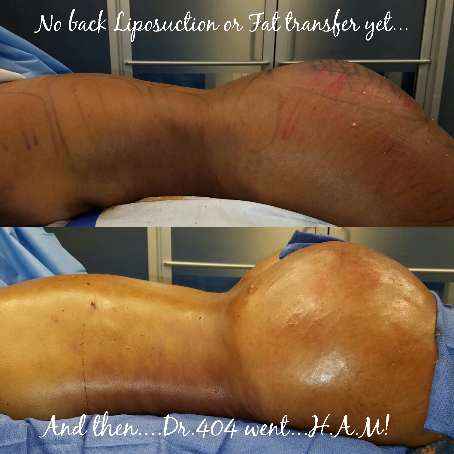 atlanta liposuction, liposuction atlanta, liposuction plastic surgery, plastic surgeon liposuction, brazilian butt lift, BBl, buttock augmentation, fat transfer